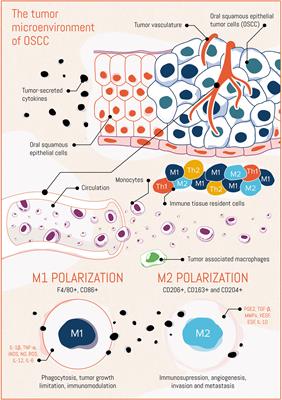 Pro-Tumorigenic Macrophage Infiltration in Oral Squamous Cell Carcinoma and Possible Macrophage-Aimed Therapeutic Interventions